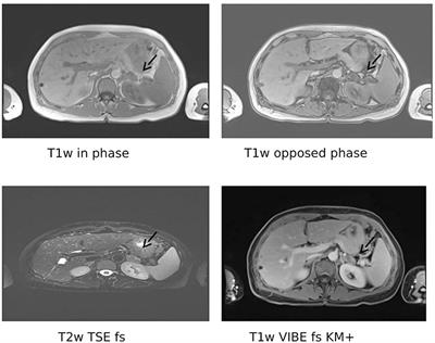 Steroid Profiling as an Additional Tool to Confirm One-Sided Hormone Overproduction in Primary Aldosteronism: A Case Report